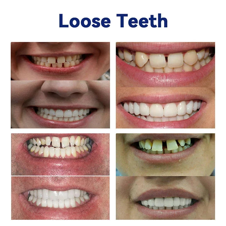 LOVILDSā¢š¦·Advanced Customized Full Denture Set𦷠(ā°Limited time discount last 30 minutesā°)