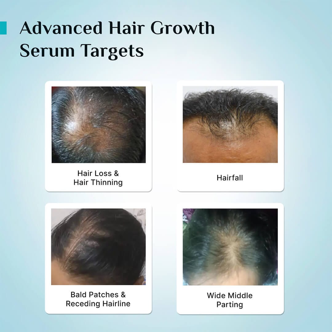 3% Redensyl + 4% Anagain Hair Growth Serum for Men